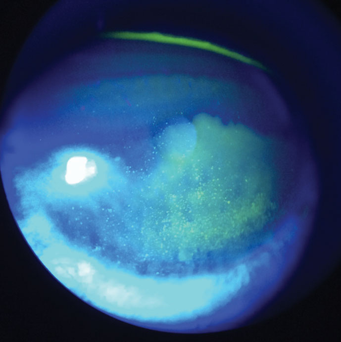 Fig. 3. At left, this patient demonstrates diffuse corneal staining with sodium fluorescein due to toxicity from multipurpose contact lens solution. 