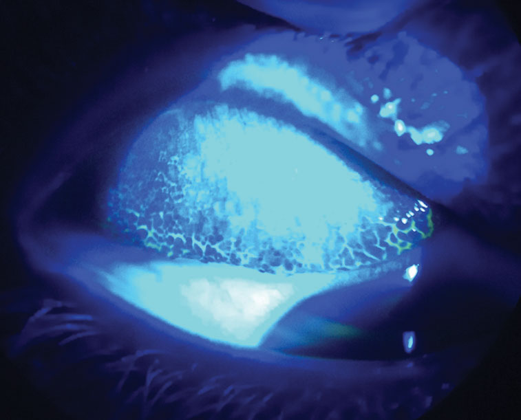 Fig. 5. By everting this patient’s upper lid and using sodium fluorescein dye with a cobalt blue light, you can see their giant papillary conjunctivitis from contact lens overwear.
