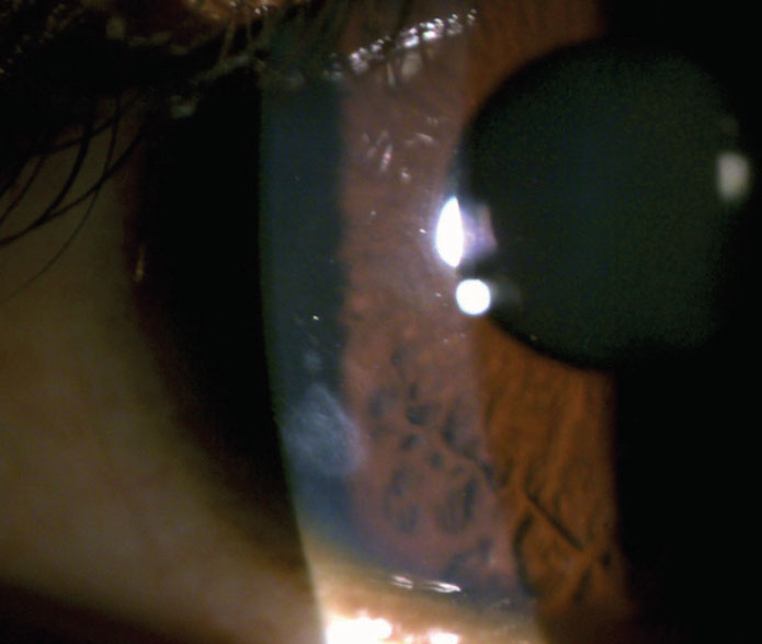 Fig. 7. You can see this patient’s residual peripheral corneal scar from a  resolved contact lens–associated corneal infiltrative event. 
