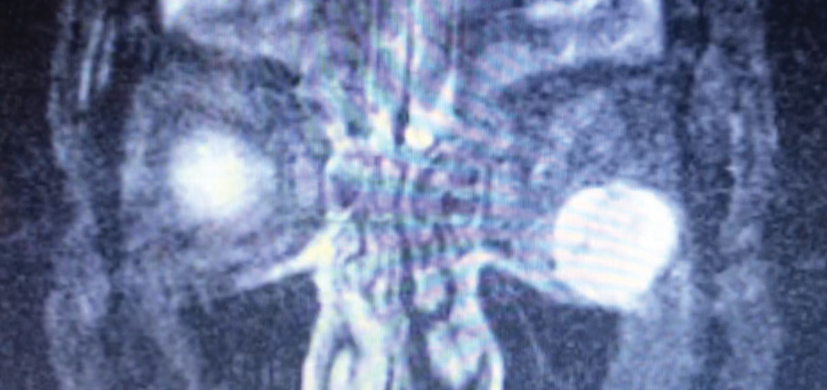 Fig. 4. This patient presented with unilateral proptosis. Exam findings suggested TAO; however, further testing, including this MRI, revealed an inferolateral postseptal orbital mass (hyperintense here) abutting the inferior and lateral rectus muscles. These features were highly suggestive of an orbital cavernous venous malformation (hemangioma).