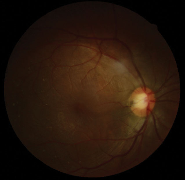 The patient presented with a temporal ODP and an elevated macula with surrounding radiating stellate pattern.