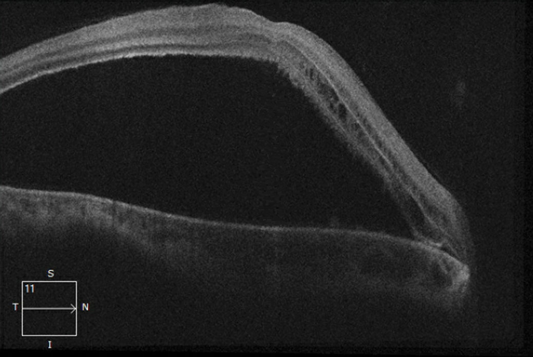 This 21-line macular OCT shows, in our patient’s right eye, a non-rhegmatogenous serous retinal detachment.