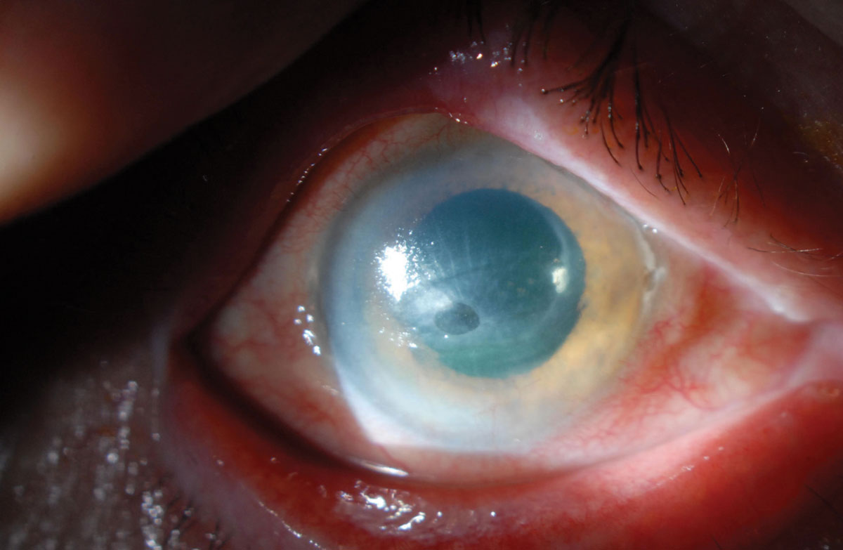 A non-healing corneal ulcer in an eye with a history of herpes zoster ophthalmicus. Note the heaped-up epithelial edges. The radial striae indicate significant corneal thinning.