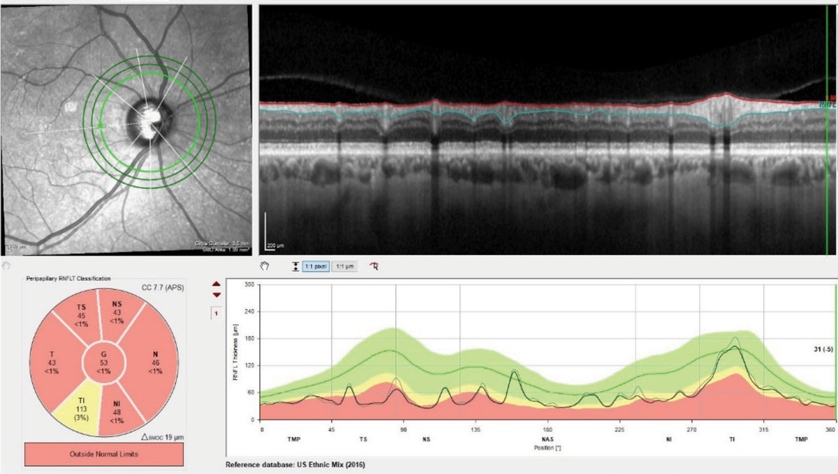 Three RNFL diameter circle scans of the patient’s right eye. Note the stability of the innermost RNFL circle scan of the most recent visit compared with the baseline visit obtained 18 months earlier. Where there is a difference between the scans, the thickness differences overlay major perioptic retinal blood vessels.
