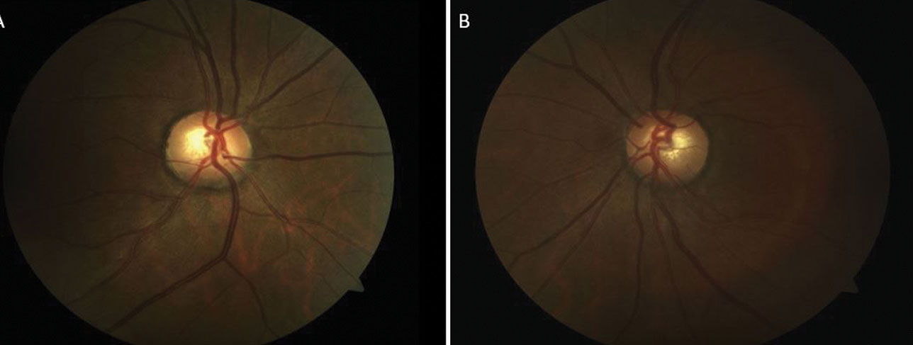 The patient’s optic nerve fundus photo shows a healthy rim and moderate cup OD (A) and OS (B). 