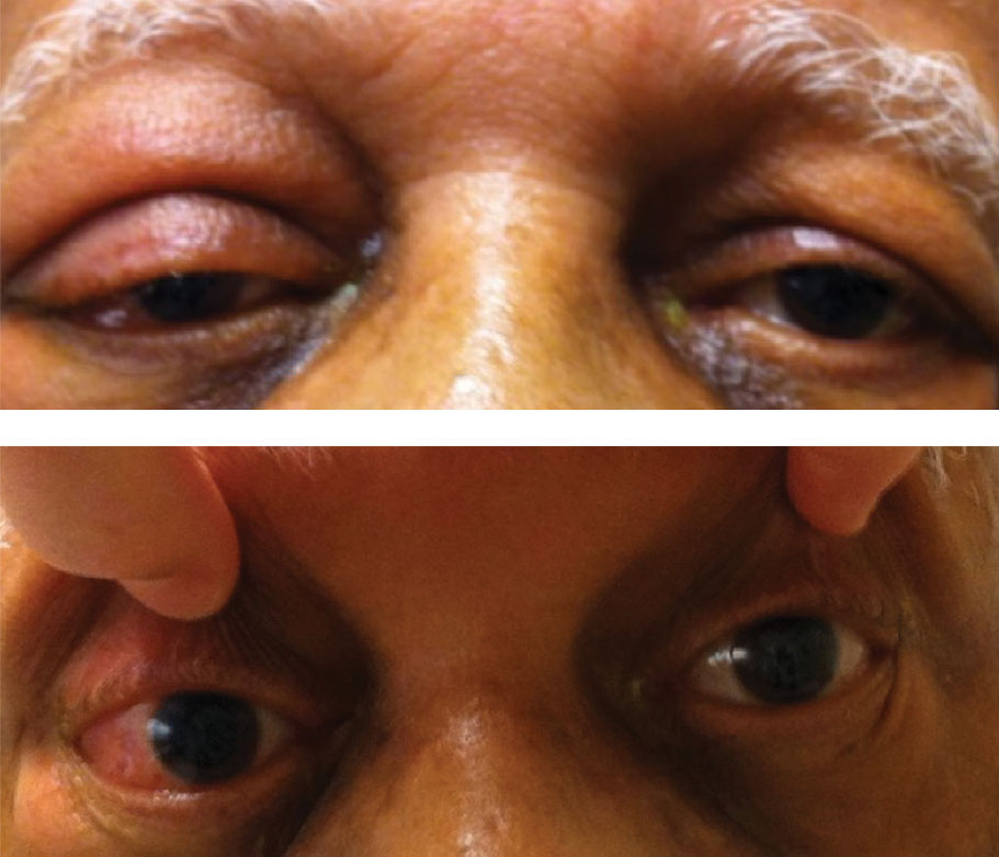 Fig. 1. This patient has marked chemosis and hyperemia in his proptotic right eye.
