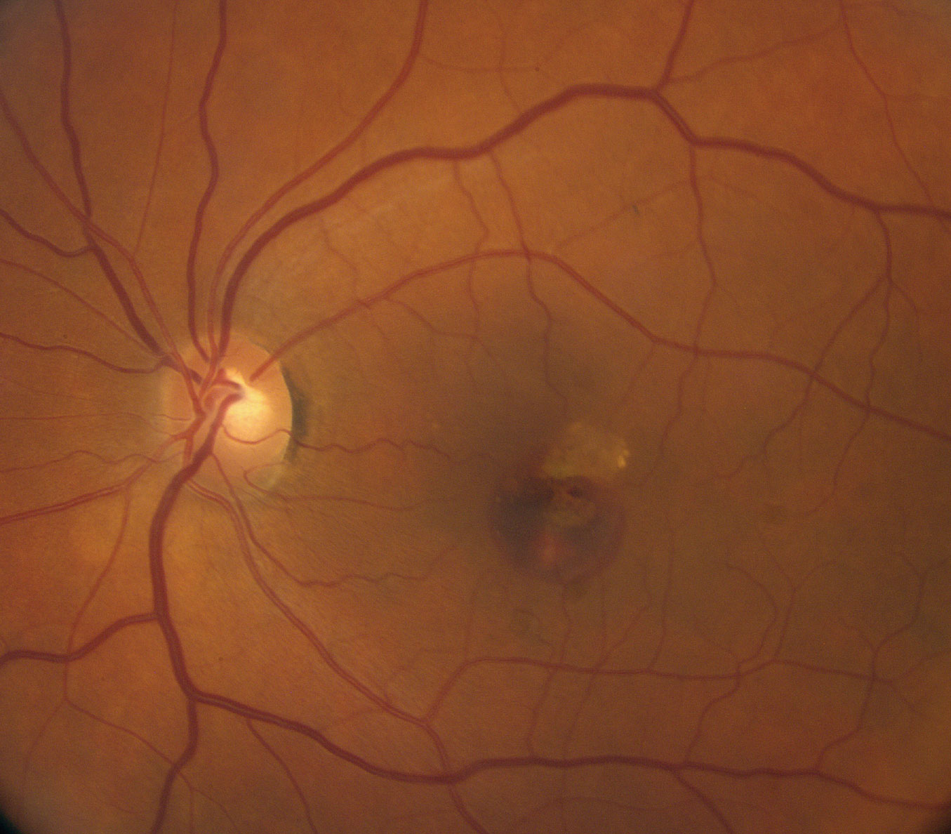 This fundus photo shows our patient’s left eye. How do you account for the hemorrhage?