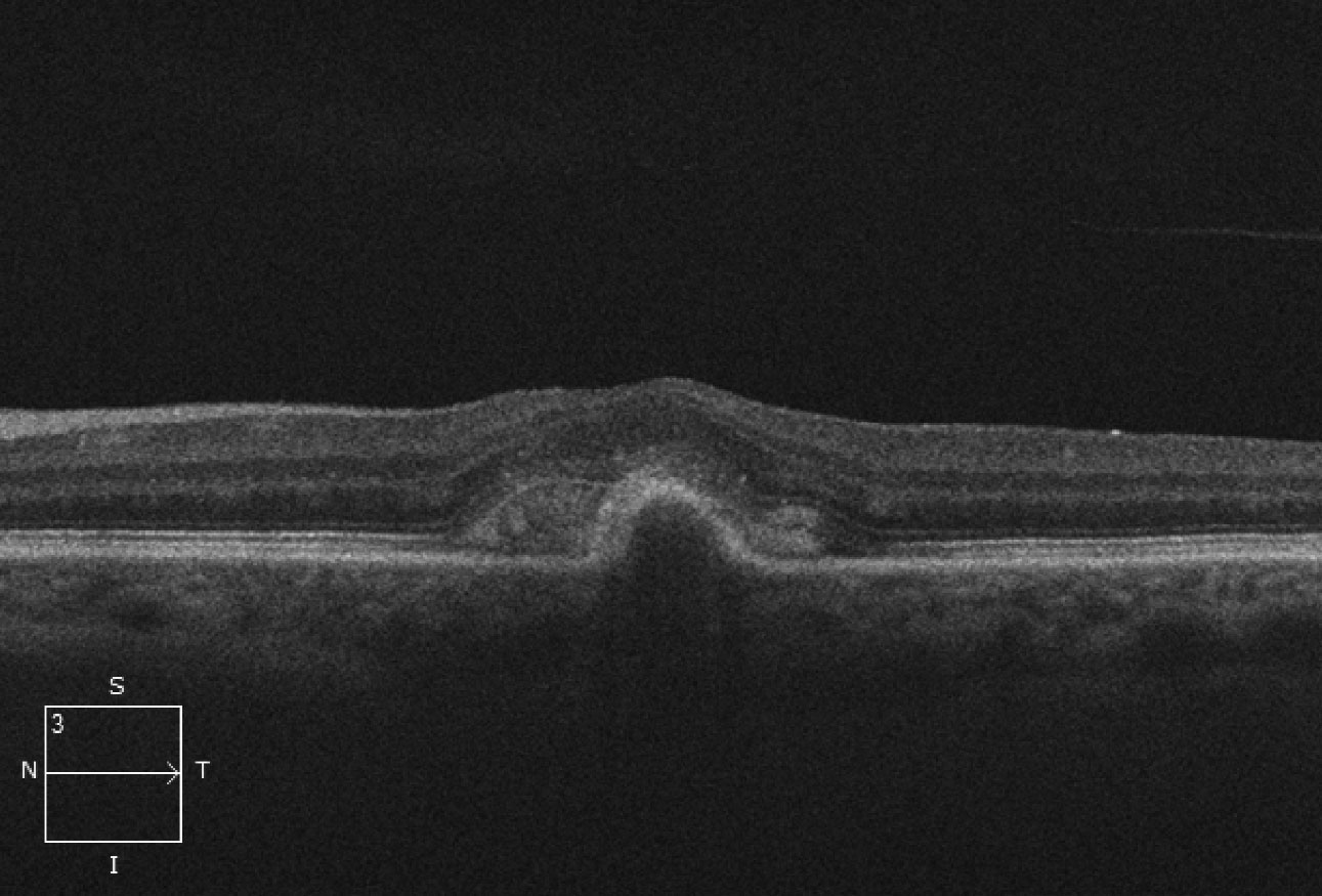 This OCT scan shows us what’s beneath the patient’s macula.
