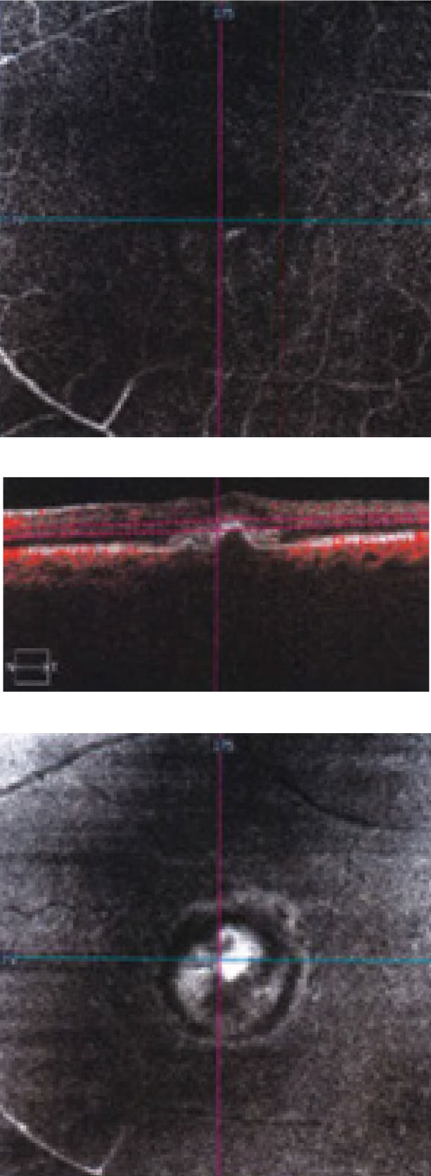 This “deep slice” OCT-A shows an en face view of through the patient’s macula.
