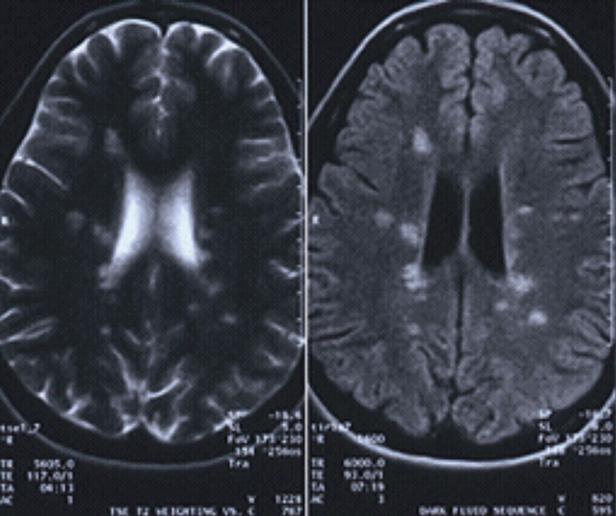 This patient’s MRI reveals classic white matter lesions perpendicular to the lateral ventricles, consistent with MS. 
