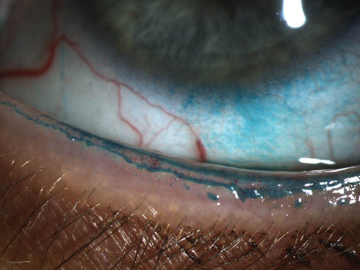 Lissamine green instilled in the eye reveals a line of Marx that transects the meibomian gland orifice. 