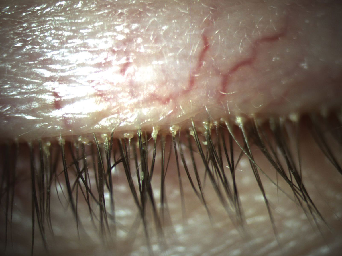 Pathognomonic cylindrical dandruff at the base of the lash due to demodecosis.