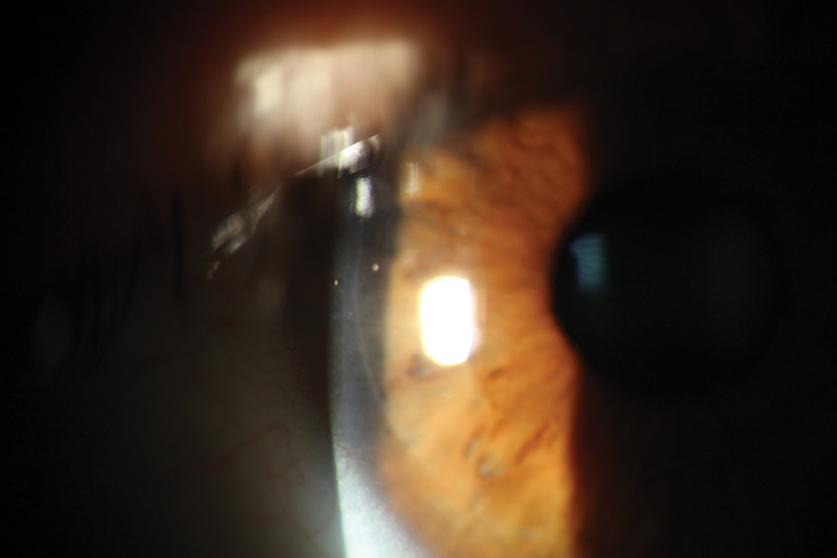 Hemochromatosis Eye