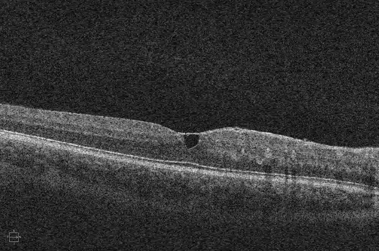 Fig. 2. We also obtained this SD-OCT image of the macula of the patient’s right eye.