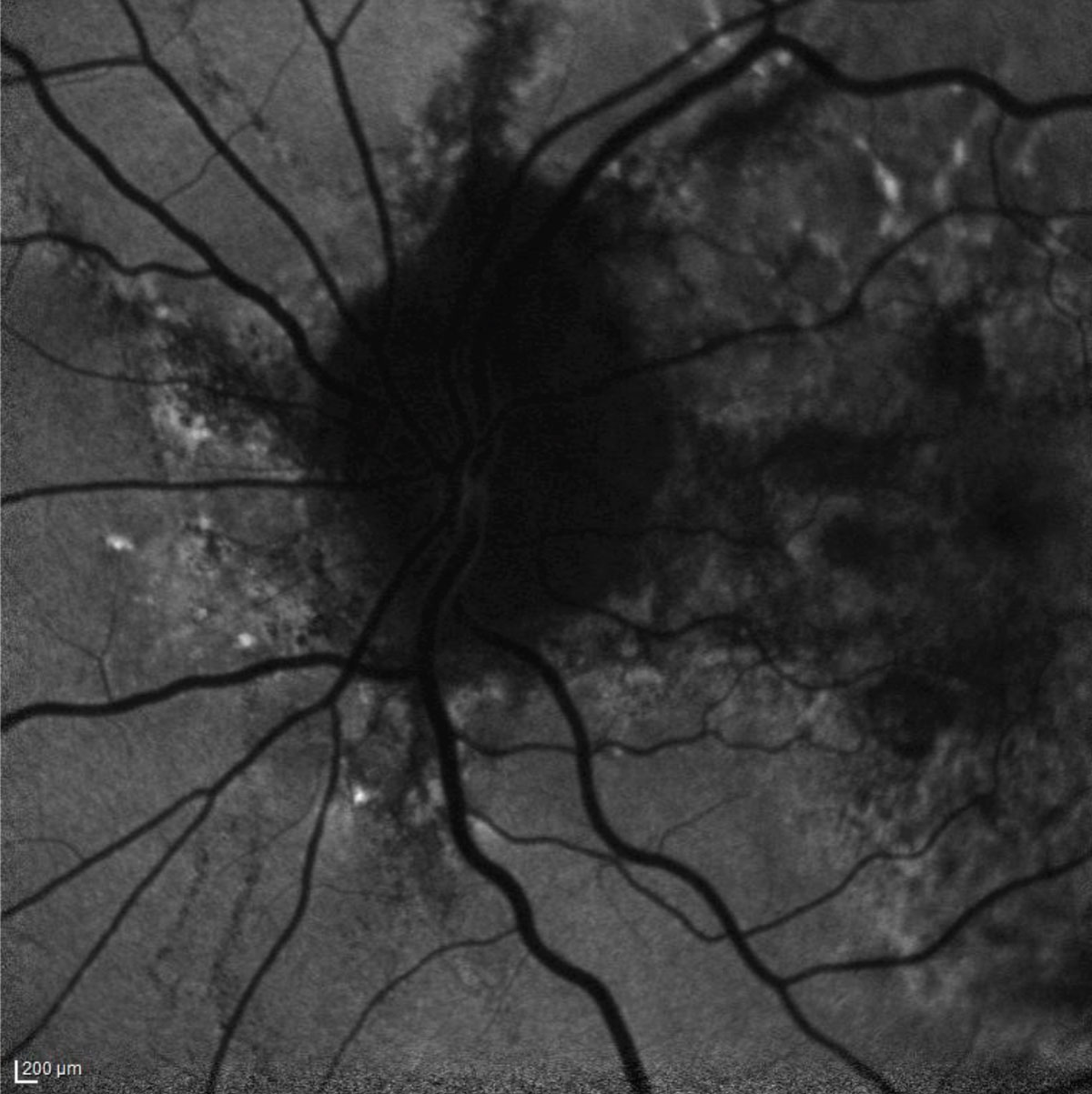 Fig. 1. The patient’s fundus autofluorescence demonstrates hyperfluorescent streaks radiating from the optic nerve that correspond clinically with angioid streaks. 