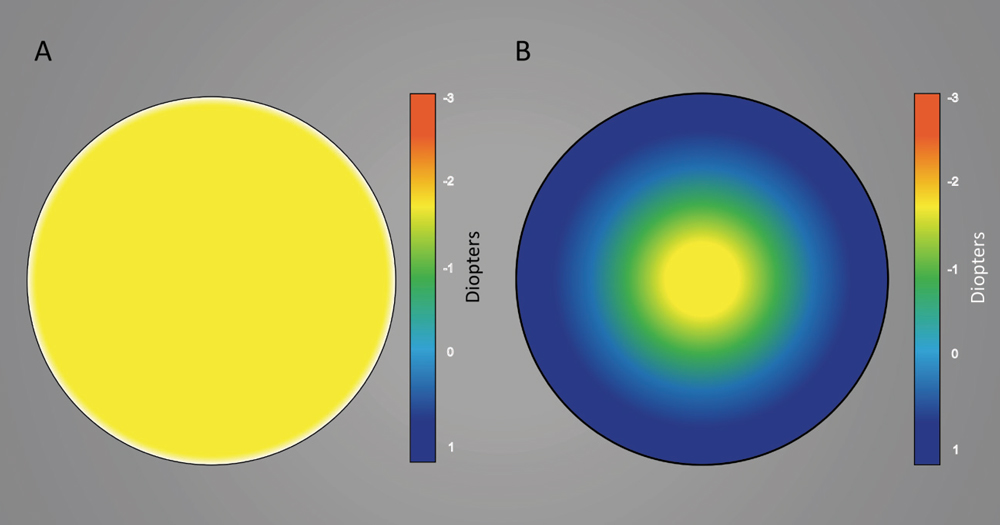 This graphic shows representations of (A) a spherical contact lens and (B) a center-distance multifocal contact lens. Image: Keyur Savla, BS. 