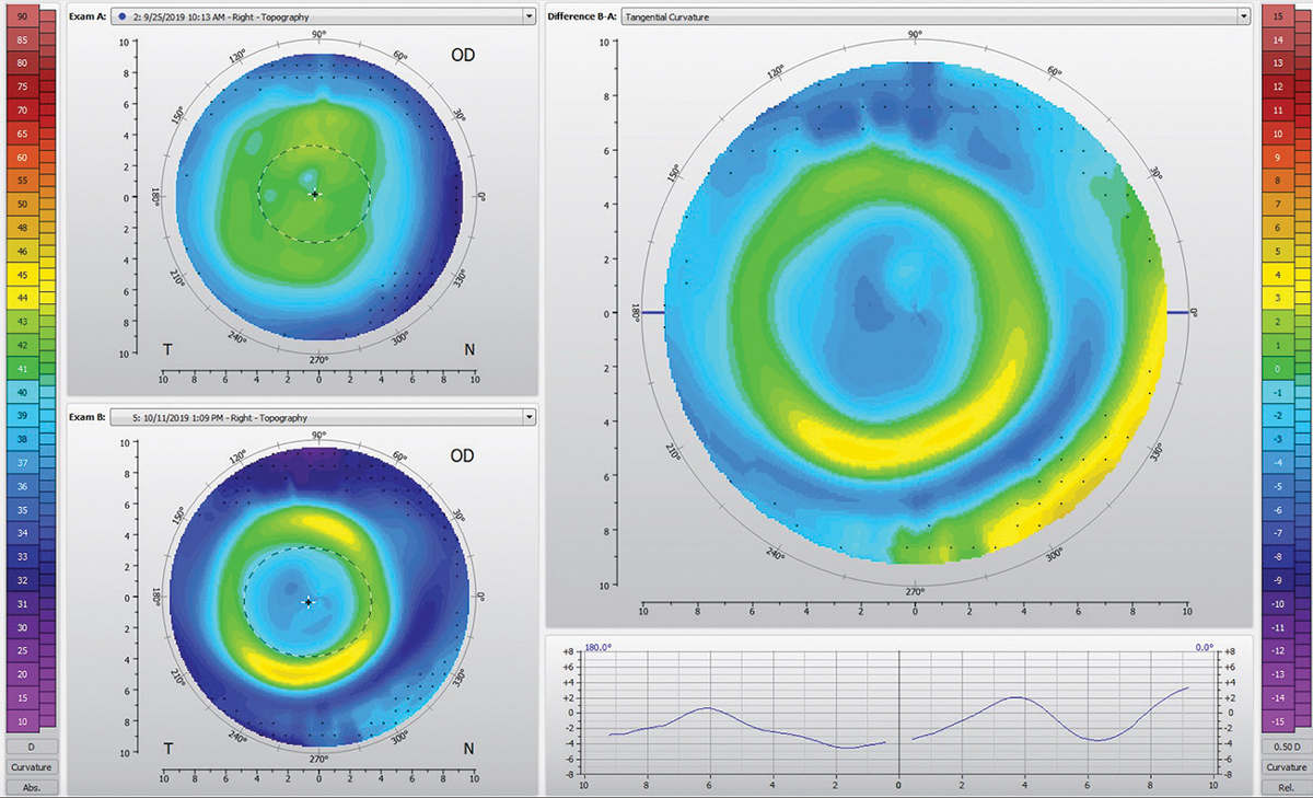 This topography shows a well-fit orthokeratology lens.