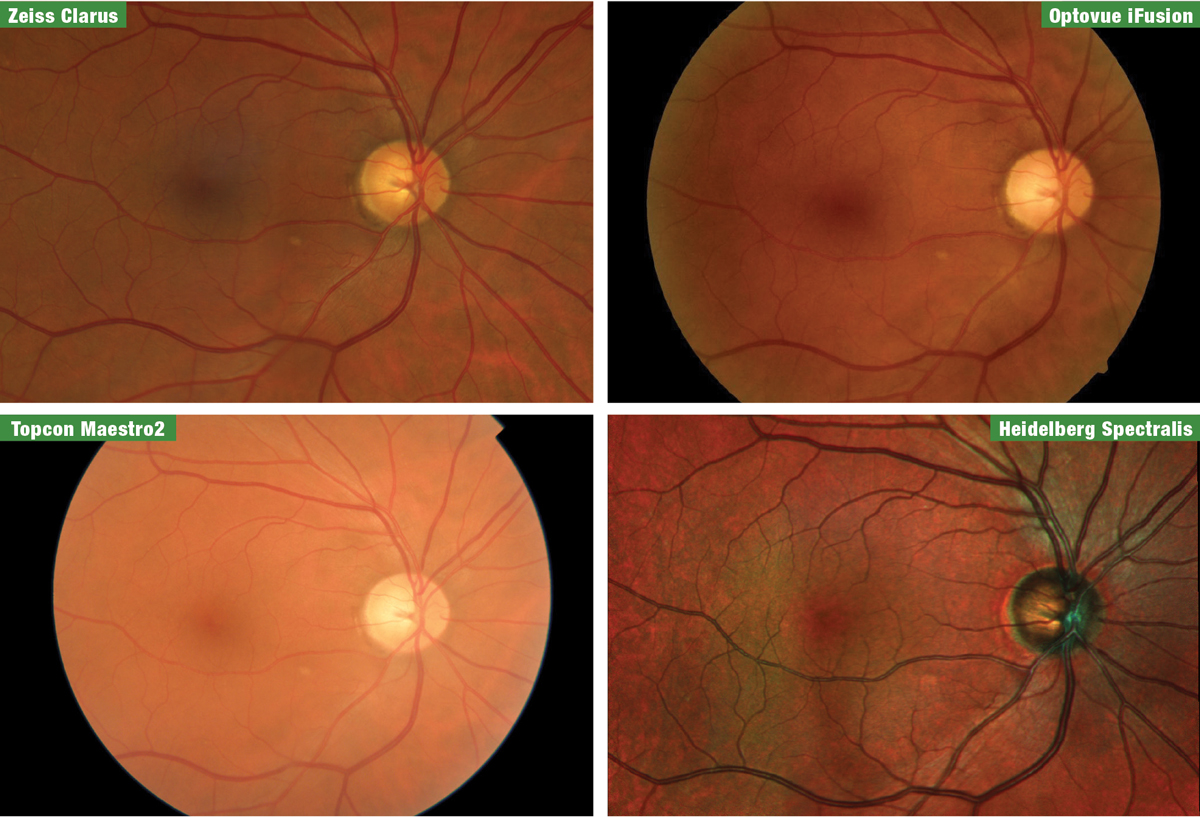 Fig. 1. Fundus images of the patient from the four manufacturers, taken at the 2019 Academy of Optometry meeting in Orlando. From top left clockwise are Zeiss Clarus, Optovue iFusion, Heidelberg Spectralis and Topcon Maestro2.