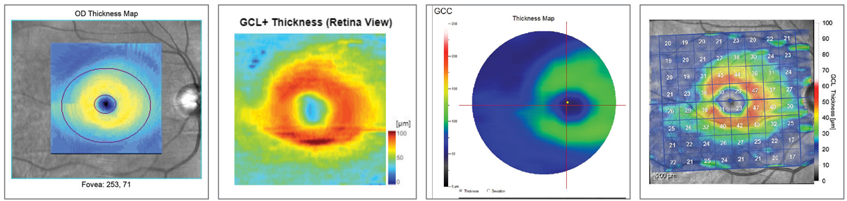 Fig. 11. Ganglion cell layer comparison. Left to right: Zeiss Cirrus 6000, Topcon Maestro2, Optovue Avanti, Heidelberg Spectralis. Note how all four instruments render the superior/inferior asymmetry.