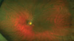 This patient has a history of hairy cell leukemia and has had leukemic retinopathy for a number of years. He later developed a hemi-retinal vein occlusion in the right eye.