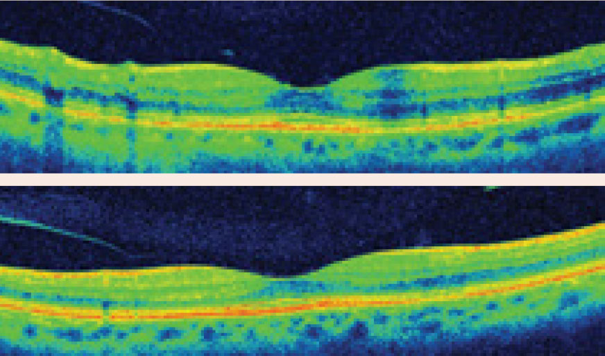 High-resolution OCT demonstrating localized parafoveal thinning in a patient with early Plaquenil toxicity.