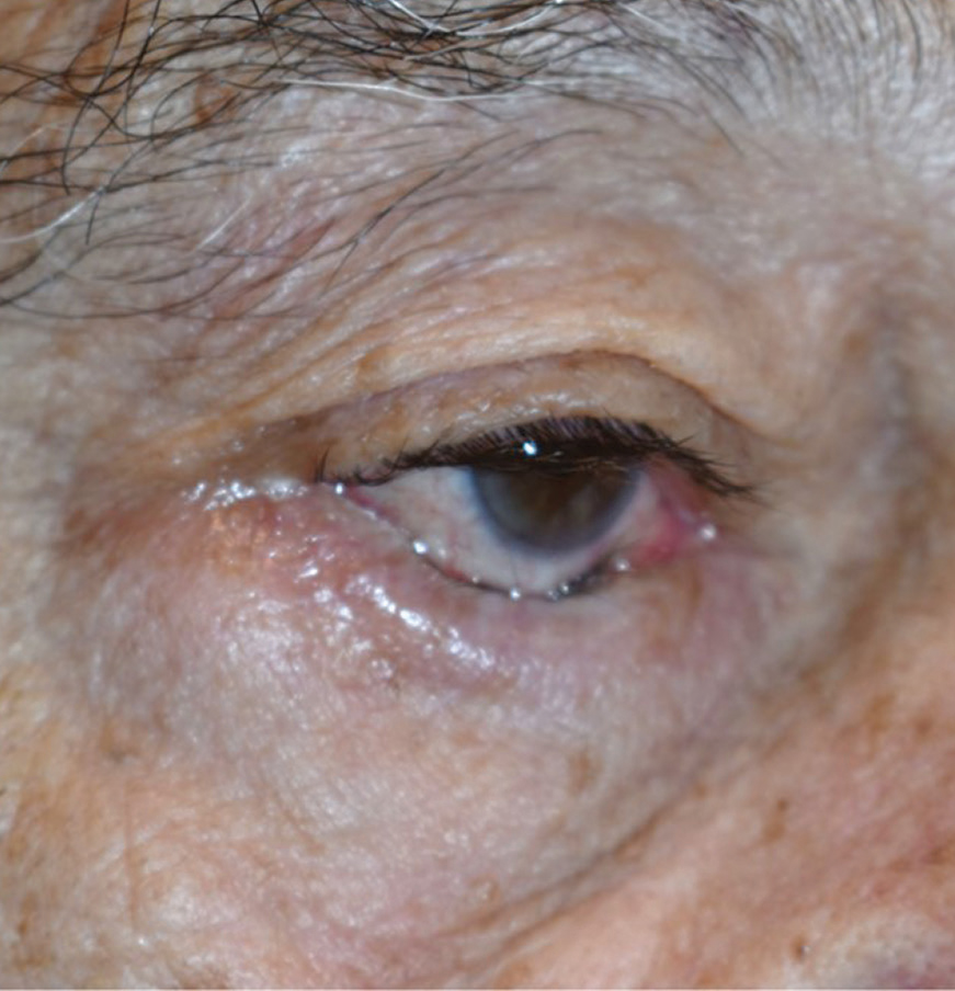 This patient’s involutional entropion is pushing their lashes into conjunctiva, compromising the ocular surface.