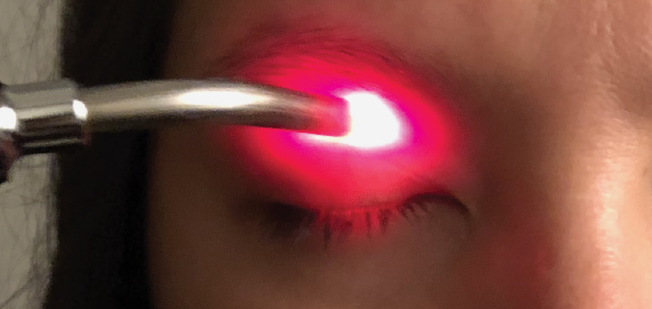 The Korb-Blackie test indicates incomplete eyelid closure when light is seen emanating from the lid margin of the eye. 