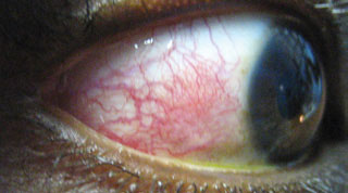 This patient demonstrates episcleritis, a presentation associated with complaints of discomfort or irritation (rather than true eye pain), redness and edema to the affected area over the sclera.
