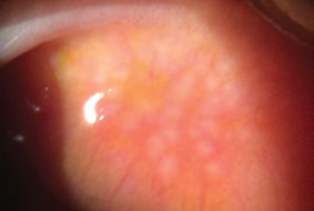Giant papilliary conjunctivitis causes this inflammation characterized by papillary hypertrophy of the superior tarsal conjunctiva.