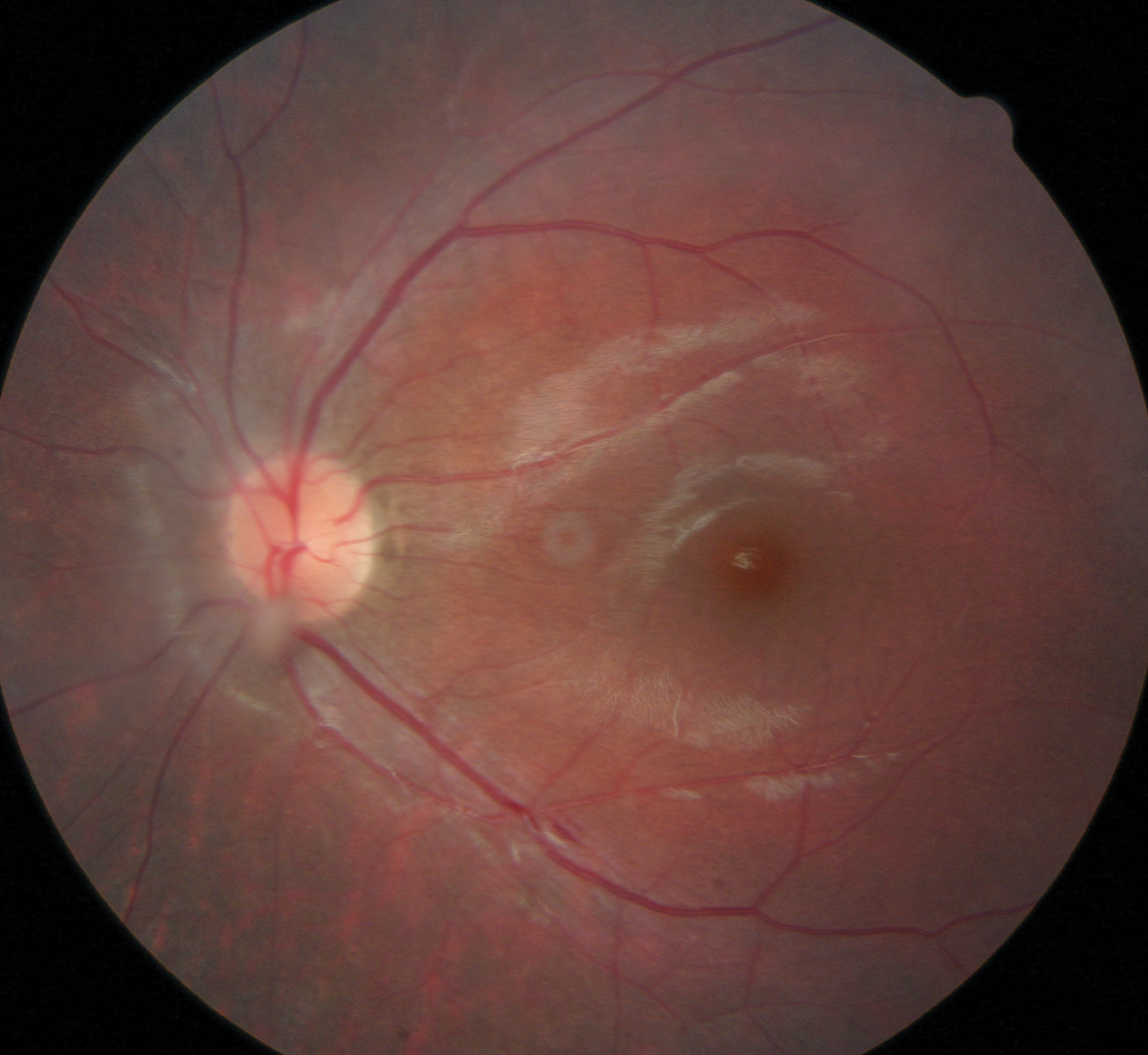 Here, a floater can be easily seen just above the bottom part of the patient’s optic nerve head. This particular floater was too close to the retina, which contraindicated laser treatment.