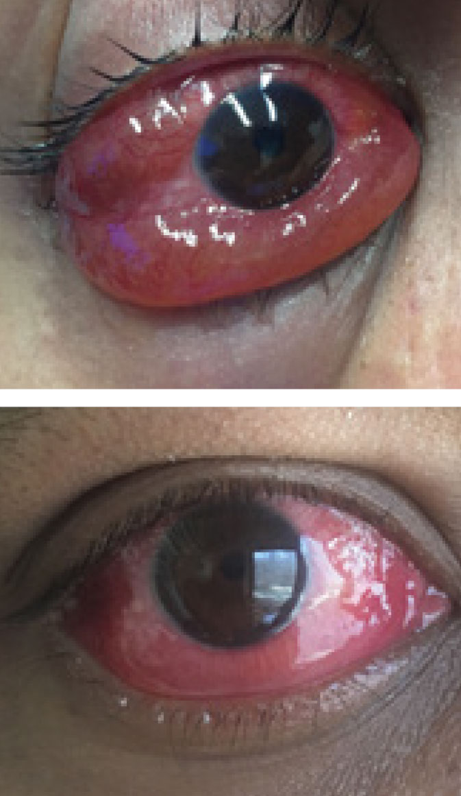 One dose of prednisone led to significant improvement of the patient’s injection and severe chemosis of the right eye.
