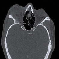 CT findings revealed swelling of right lateral rectus muscle and lacrimal gland, which helped narrow down the diagnosis to IOI.