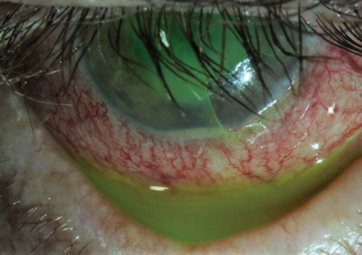 Fig. 2. This patient presented with a corneal abrasion and hypopyon. He was treated successfully with a bandage contact lens, a topical steroid and a topical antibiotic.