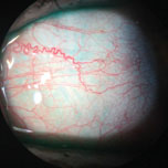 This patient’s inflamed blood vessels can be seen without any vital dyes. 