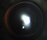 The ring pattern indicates that the patient has a multifocal IOL, though it may be difficult to identify the specific lens based on appearance.