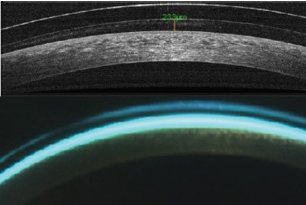 Fig. 2. AS-OCT (top) and biomicroscopy of central scleral lens clearance.
