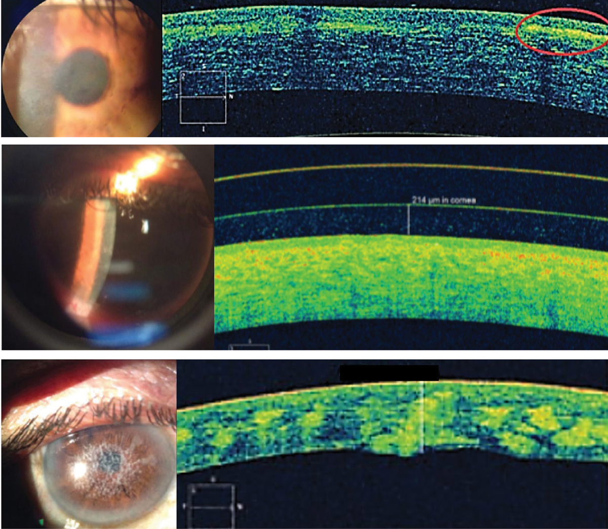 Fig. 7. From the top, Reis-Bücklers corneal dystrophy, lattice corneal dystrophy and type 1 granular corneal dystrophy with hyper-reflective deposits at Bowman’s layer, in the anterior stroma and in the stroma, respectively. 