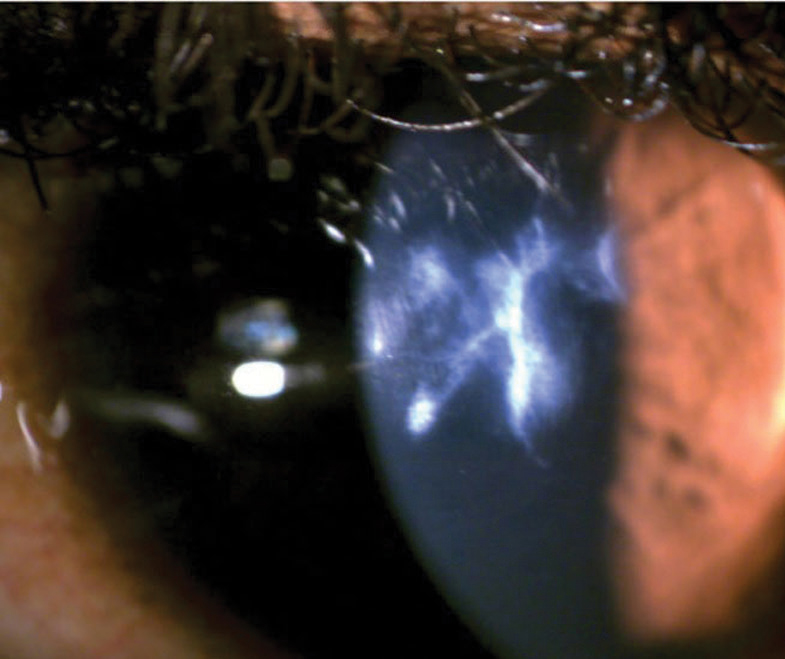 Fig. 11. Accurately assessing the anterior chamber reaction with a slit lamp would be challenging in this case of severe keratoconus with a scarred cornea.