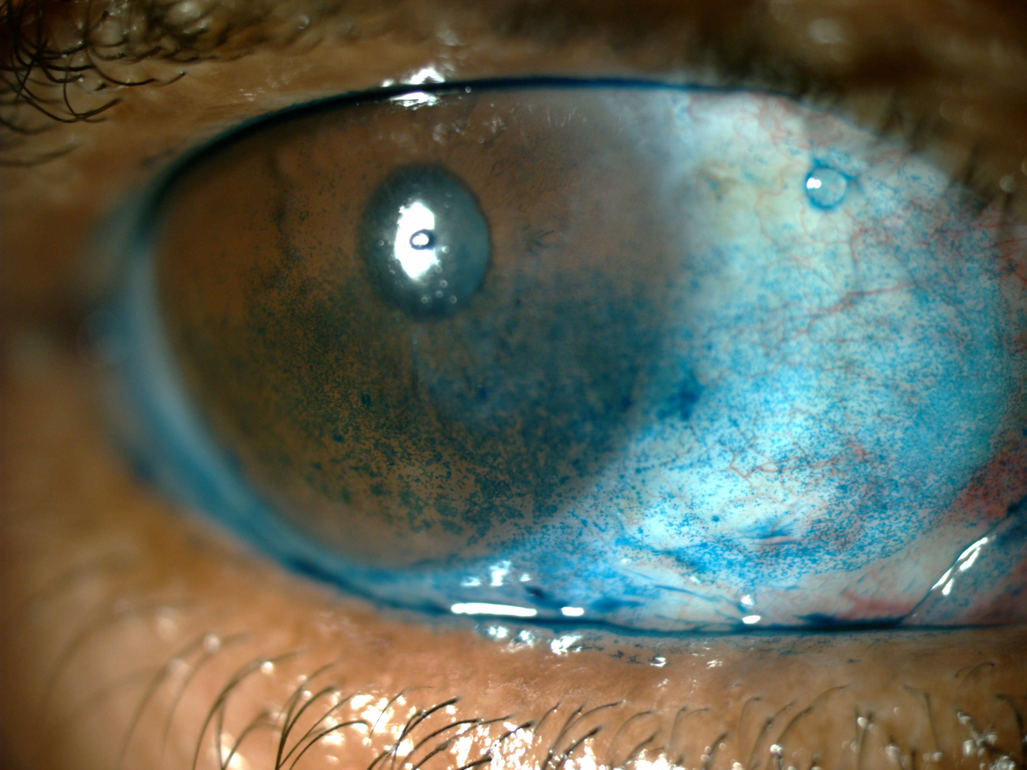 Severe dry eye patients with advanced corneal staining are ideal candidates for autologous serum tears.
