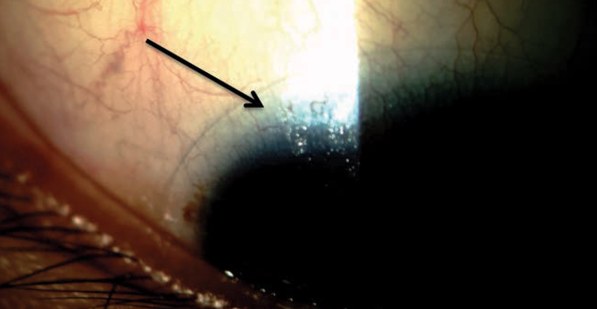 Uncovering poor tear film stability caused by meibomian gland dysfunction, which results in the lipid layer thinning (arrow), can help you treat patients before they struggle with contact lens wear. 