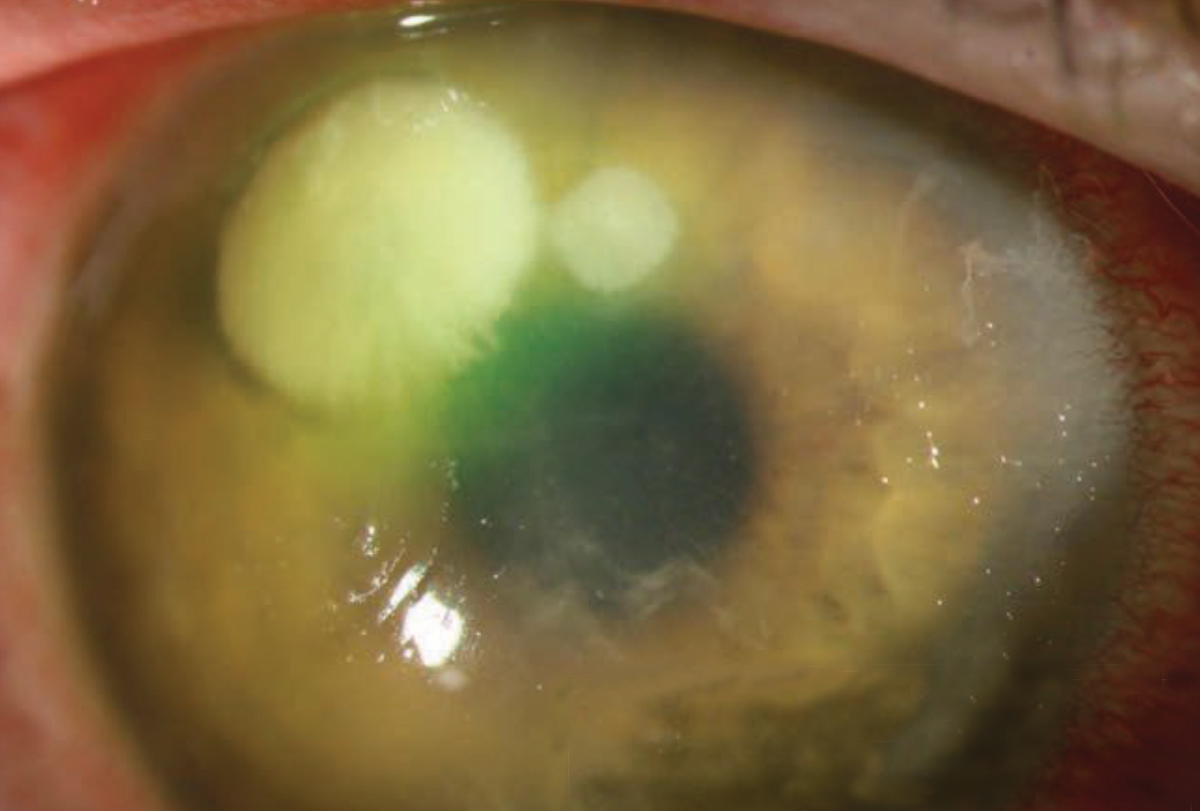 Patients who have a history of a corneal ulcer, such as this one with a Pseudomonas ulcer, may do better with a daily disposable lens option—and plenty of patient education on proper lens wear and care.