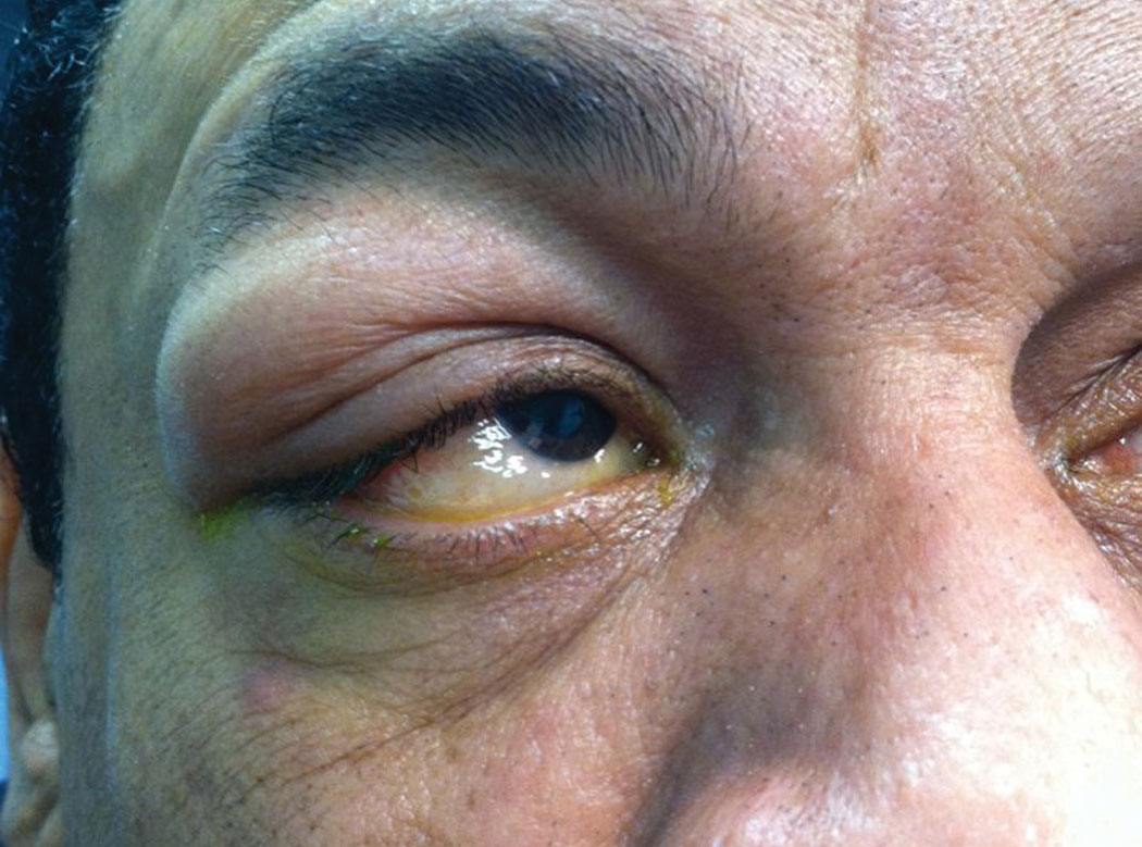 Fig. 1. This patient went to sleep feeling fine, but something went bump in the night—his eyelid. Can you identify what caused this and how he should be treated?