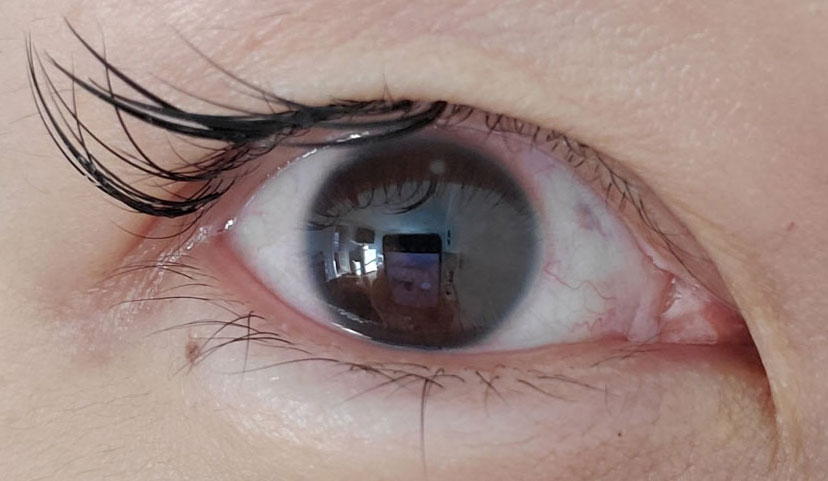 Doctors can keep using telehealth for some conditions easily identified with an external exam and a good history. This patient was diagnosed, via telehealth, with a corneal infiltrate due to overnight contact lens wear.