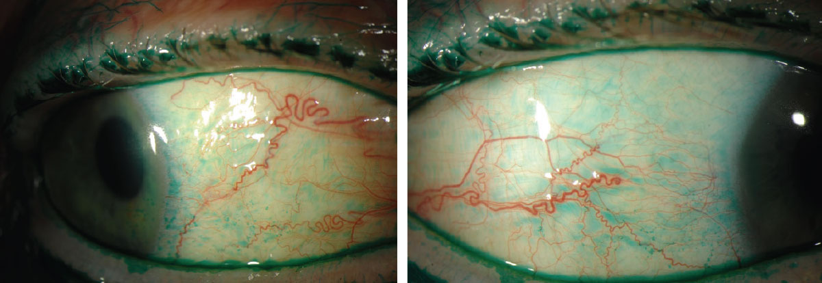 Lissamine green staining on the conjunctiva reveals signs of dry eye. 