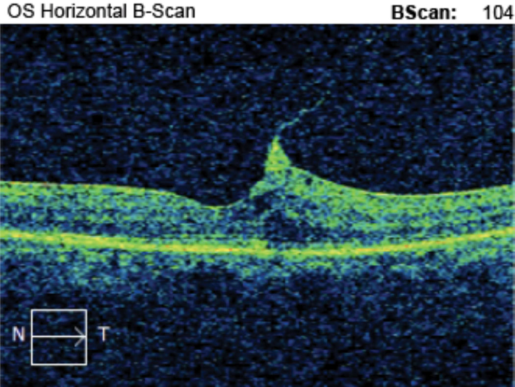 Case 1. This is the horizontal OCT B-scan of the left eye of an 85-year-old black male patient with VMT who is being monitored. BCVA is 20/50- OS. He reports metamorphopsia on the Amsler grid but denies scotoma. We discussed monitoring vs. surgical consultation, and the patient prefers to self-monitor with Amsler grid. He is being followed every three months with serial macular OCT and dilated fundus exam.