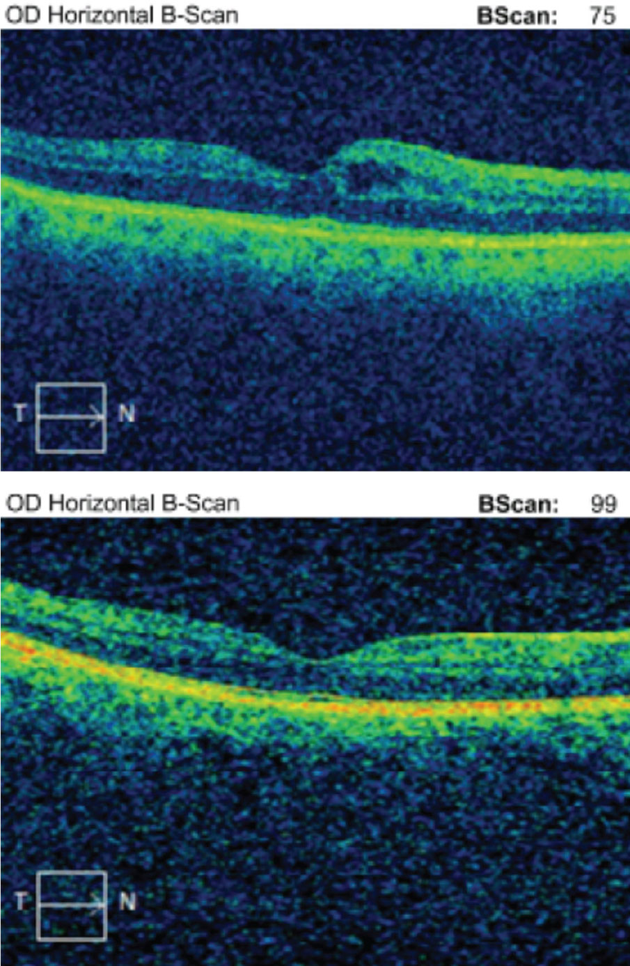 Case 3. Above is the initial macular OCT scan of a 64-year-old black female who developed IGS nine weeks post-op in the right eye. BCVA was 20/40. Below is her macular OCT scan after 11 weeks of difluprednate 0.05% and ketorolac 0.5% therapy in the right eye. Her BCVA resolved to 20/20.