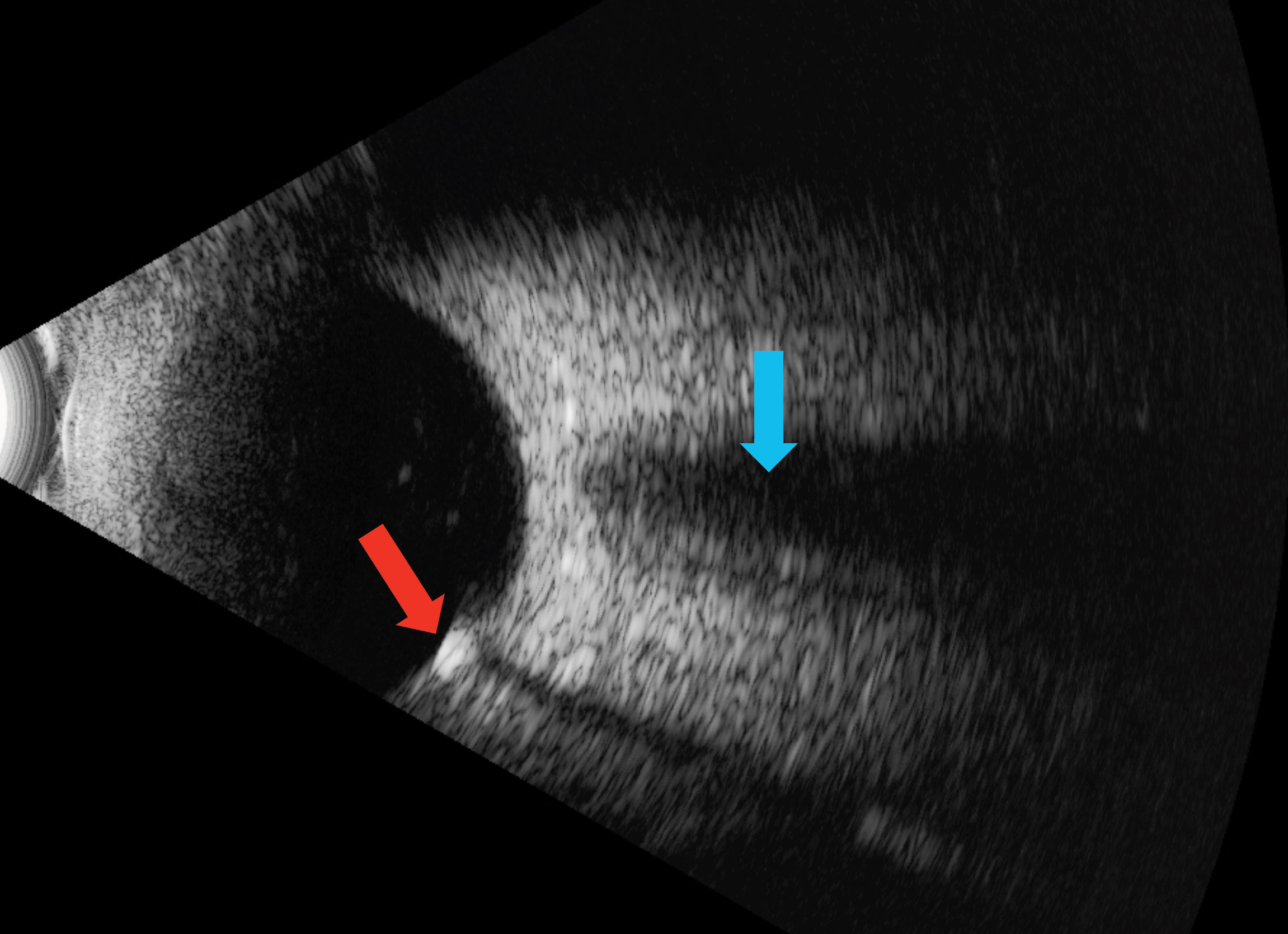 The red arrow shows an echo-dense placoid lesion while, the blue shows acoustic orbital shadowing on this B-scan ultrasound.