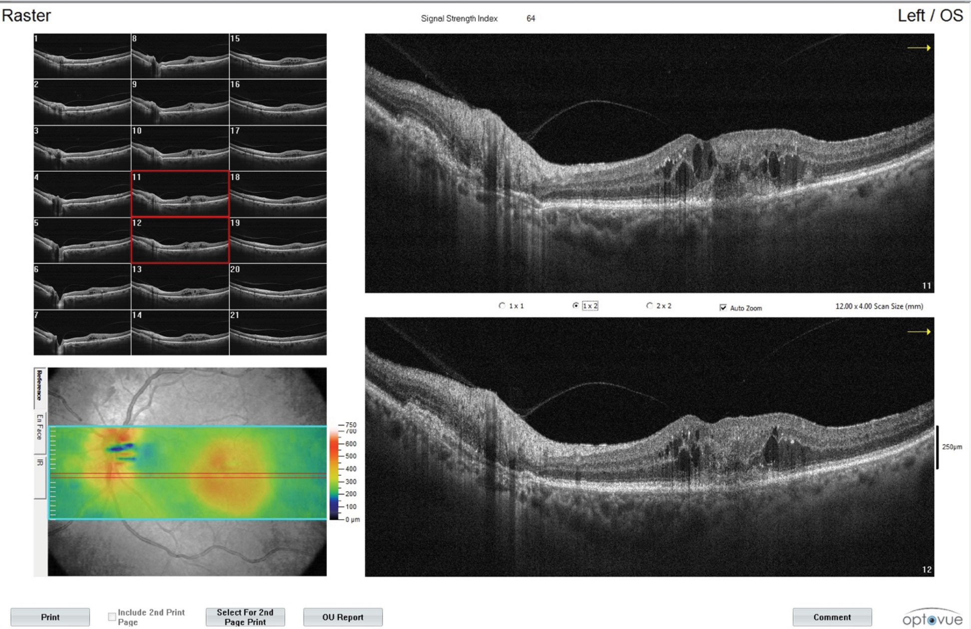 These images show additional findings from the CNVM patient with intraretinal fluid in the left eye. Monitoring is a key part of the OD’s role in managing patients undergoing anti-VEGF shots.