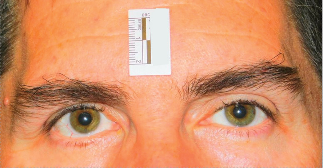 This clinical study subject is seen five minutes after instillation of RVL-1201 for the treatment of ptosis.