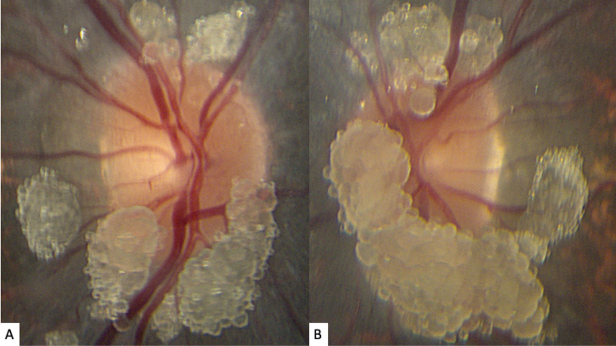 Fig. 1. These photos of our young patient’s right (A) and left (B) optic nerves show extensive elevated, globular lesions of both the optic nerve and peripapillary retina.